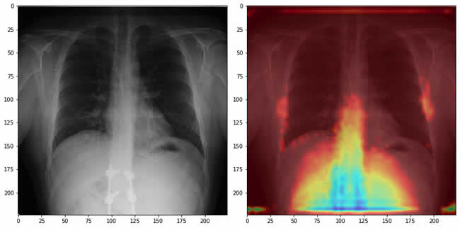 RedSalud y Google realizan estudio para apoyar detección de Covid-19 usando rayos X con IA